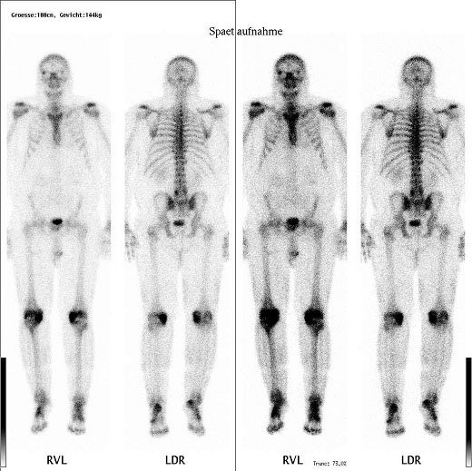 39+ Rheuma skelettszintigraphie bilder deuten , Skelettszintigraphie Leistungsspektrum Diagnostikum Nuklearmedizin